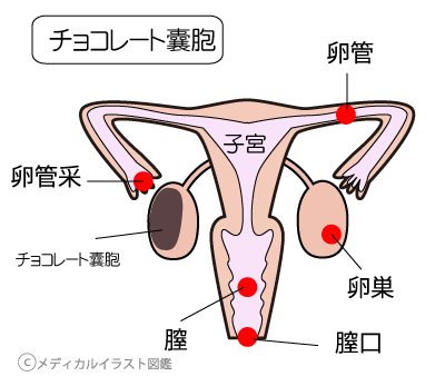 卵巣チョコレート嚢胞、妊娠妊活でお悩みなら千葉県千葉市整体